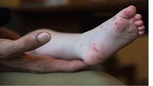 hand foot and mouth disease  signs   symptoms   complications   prevention and treatment